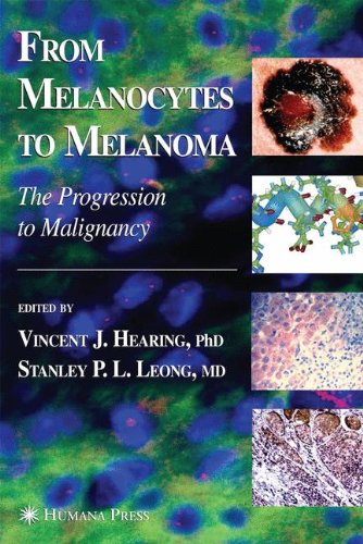 From Melanocytes to Melanoma: The Progression to Malignancy